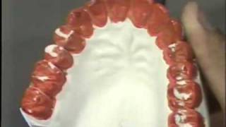 Occlusal Adjustment  Protrusive Movement [upl. by Ahsimet]