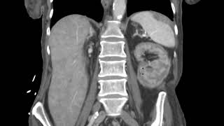 Renal cortical necrosis on CT [upl. by Perlis]