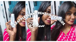 Epiduo geladapaleneBenzoyl peroxide review in tamil acne reviewintamil [upl. by Aniela]