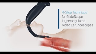 How to Intubate Using a GlideScope® Video Laryngoscope in 4 Steps [upl. by Couq411]