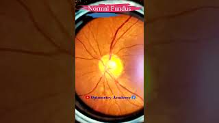 Normal fundus  Normal Retina  Smartphone Fundus Videography  Fundus Photography  Short Video 85 [upl. by Rede]