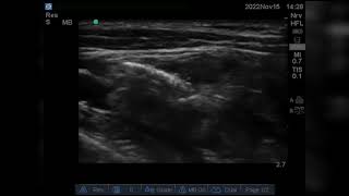 Ultrasound guided Costoclavicular brachial plexus block [upl. by Elocon]