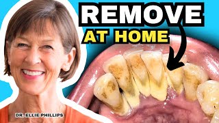 Tartar Removal At Home and How To Prevent Tartar [upl. by Latt]