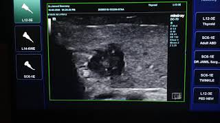 Papillary Thyroid Cancer Ultrasound [upl. by Siroved]