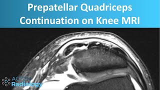 Prepatellar Quadriceps Continuation on Knee MRI  Anatomy and Pathology [upl. by Gilges]