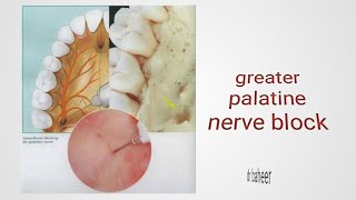 greater palatine nerve block and palatal approach of maxillary nerve block [upl. by Icat]