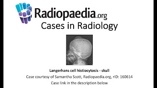 Langerhans cell histiocytosis  skull Radiopaediaorg Cases in Radiology [upl. by Tempest163]