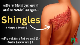 shingles disease symptoms causes treatment and vaccine information in hindi [upl. by Katsuyama]