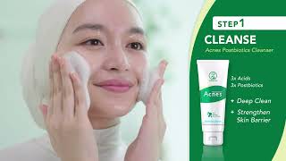 Acnes 3 Simple Steps to AcneFree Skin [upl. by Moser]