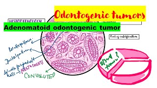 Adenomatoid odontogenic tumor HISTOPATHOLOGYradiographic featuresclinical featuresTreatment [upl. by Laverne125]