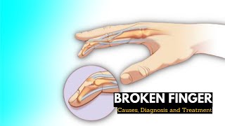 Broken finger Causes Signs and Symptoms Diagnosis and Treatment [upl. by Ornstead]