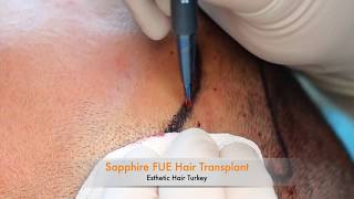 Sapphire FUE Hair Transplant Esthetic Hair Turkey [upl. by Mallissa]