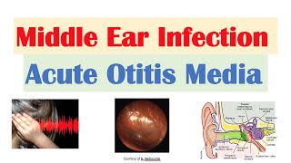 Middle Ear Infection Acute Otitis Media  Causes Symptoms Diagnosis Treatment [upl. by Selinski]