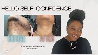 Electrolysis Changed My Life  Best Solution for Hirsutism Ingrown Hairs and PCOS [upl. by Haggai]