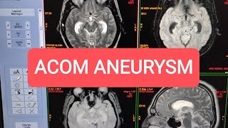 Subarachnoid Haemorrhage SAH MRI scan Findings  MRI Aneurysm [upl. by Walton]