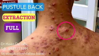 Mụn trứng cá mủ lưng cực nặngDermatologistpimpleswhiteheadacne conglobata pustule extraction ful [upl. by Hugibert]