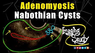 Adenomyosis with Nabothian Cysts  Ultrasound  TVS  Case 255 [upl. by Resaec]