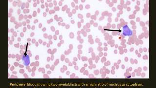 Pediatric Leukemia and lymphoma [upl. by Kliman]