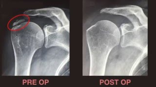 Dr Bruno LEVY  Traitement arthroscopique des calcifications de lépaule [upl. by Reyaht]