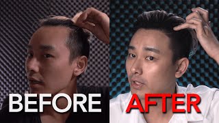 Hair Transplant in Korea Results After 1 Year [upl. by Ynoyrb77]