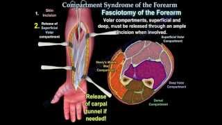 Compartment Syndrome Of The Forearm  Everything You Need To Know  Dr Nabil Ebraheim [upl. by Huebner]