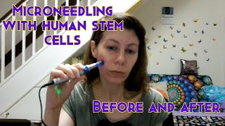 Microneedling with stem cell serum Does it work [upl. by Limbert]