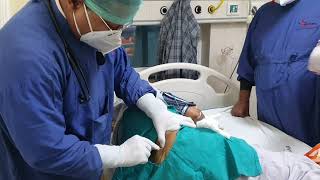 Bone Marrow Aspiration and Biopsy Dr Sandeep Kumar garg Nutema Hospital [upl. by Rosalind]