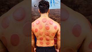 cupping therapy🤯 [upl. by Cattier]