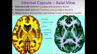 Brain Internal Capsule Demonstration Video  Sanjoy Sanyal [upl. by Livy]