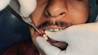 Fast and painless removal of Root stump of grossly decayed molar tooth [upl. by Owena]