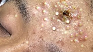 Big Cystic Acne Blackheads Extraction Blackheads amp Milia Whiteheads Removal Pimple Popping  9281 [upl. by Adnilema]