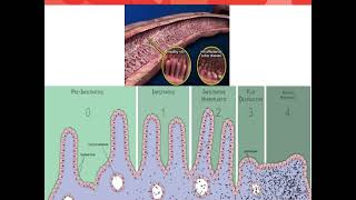 Celiac Disease Getting Started on Gluten Free Diet [upl. by Ethelda]