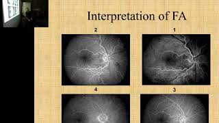 Fluorescein Angiography Dr Mahmood Mekkawy [upl. by Hilel497]