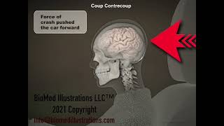 Coup Contrecoup Whiplash Brain Injury [upl. by Eglantine998]