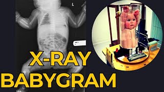 Babygram Xray ll positioning of babygram Xray ll How to perform Babygram Xray ll [upl. by Ettenrahs163]