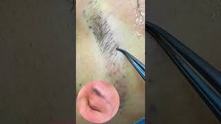 Eyebrow transplant hair transplant eyebrow hairtransformation hairgoals eyebrowmodification [upl. by Piefer]