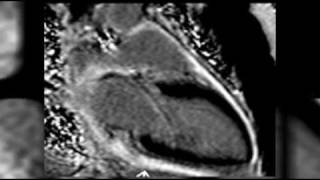 Cardiac MRI Cases on radRoundscom Radiology Network [upl. by Harry]