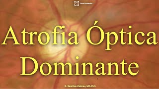 Atrofia Óptica Dominante [upl. by Belden378]