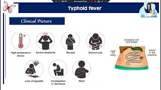 Practical Diagnosis of typhoid fever plague undulant fever [upl. by Juback79]