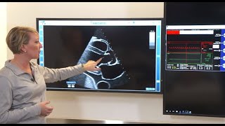 Managing Impella Position Using Imaging [upl. by Eceinart620]