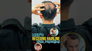 Hair Loss Receding Hairline Treatment [upl. by Jenesia]