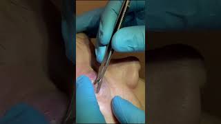 iExpressor Meibomian Gland Forceps video [upl. by Siuoleoj108]