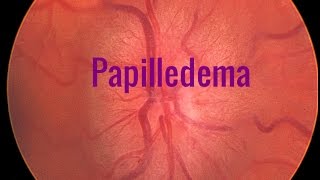 Papilledema A Swollen optic disc [upl. by Azirb337]