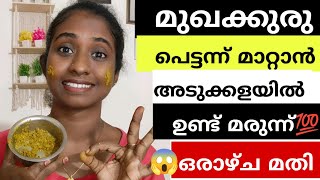 💯പെട്ടന്ന് മുഖക്കുരു മാറ്റണോഇതു മാത്രം മതി😱💯working🔥Pimples Remove Pack at Home💯youtube [upl. by Clothilde]