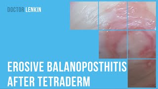 😟 Erosive balanoposthitis after tetraderm [upl. by Horan]