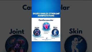 Ehlers Danlos Syndrome  Manifestations shorts [upl. by Yesrej]