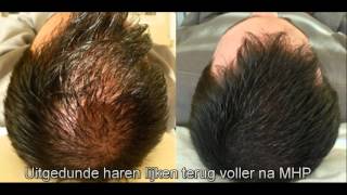 Micro haar pigmentatie belgie nederland [upl. by Dalury]