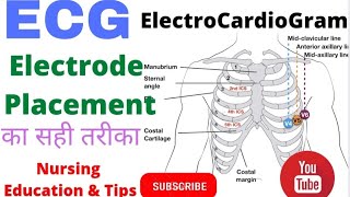 ECG ElectroCardiaGram ECG placement ECG ChestLead proper wayHow to Place ECG electrodeHindi me [upl. by Aydin]