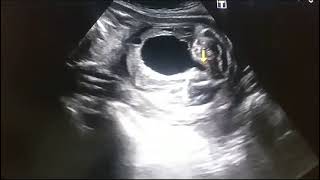 Posterior urethral valve obstacle ultrasound do watch and subscribe us [upl. by Ettenig156]