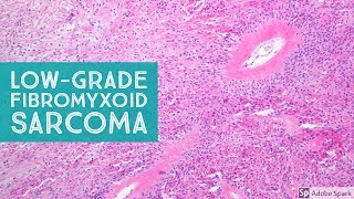 LowGrade Fibromyxoid Sarcoma Evans Tumor 101Explained by a Sarcoma Pathologist [upl. by Anidnamra]